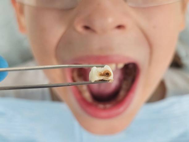Best Knocked-Out Tooth Emergency  in Pistakee Highlands, IL